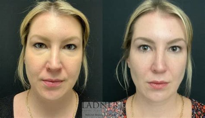 
Lady Victoria Hervey | Plastic Surgery Before And After 
